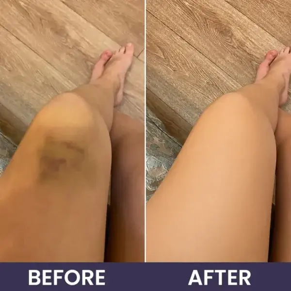 Bruise Recovery Cream - Image 14