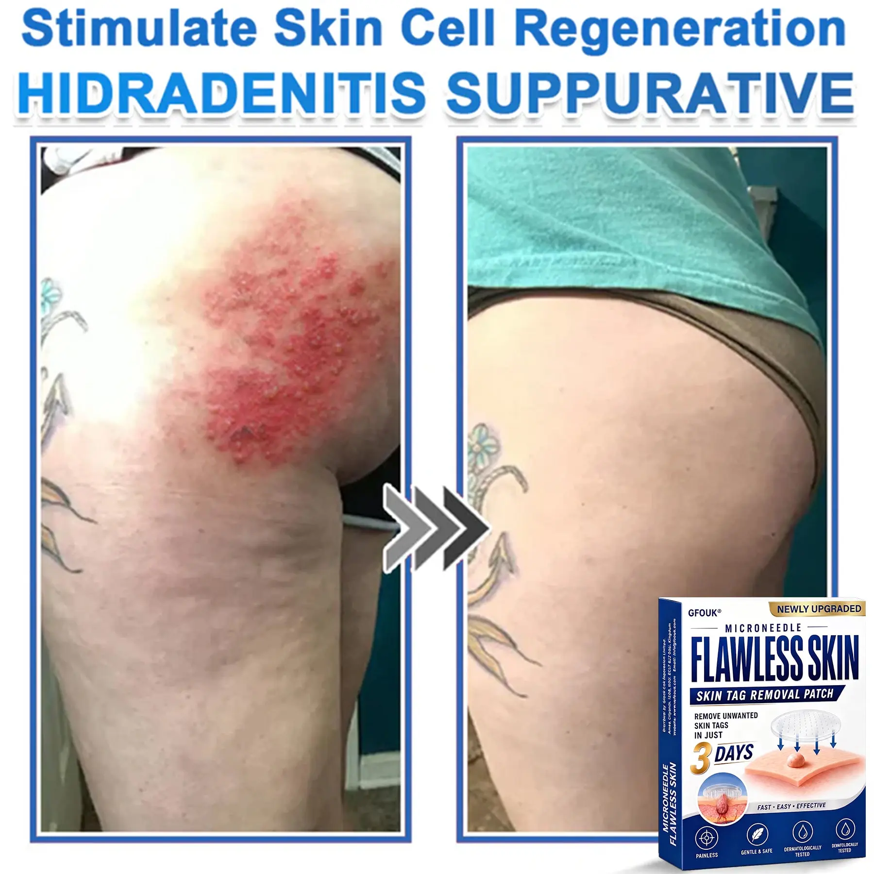 GFOUK® 2026 Newly Upgraded 2-in-1 Microneedle Hydrocolloid Patches - Image 10