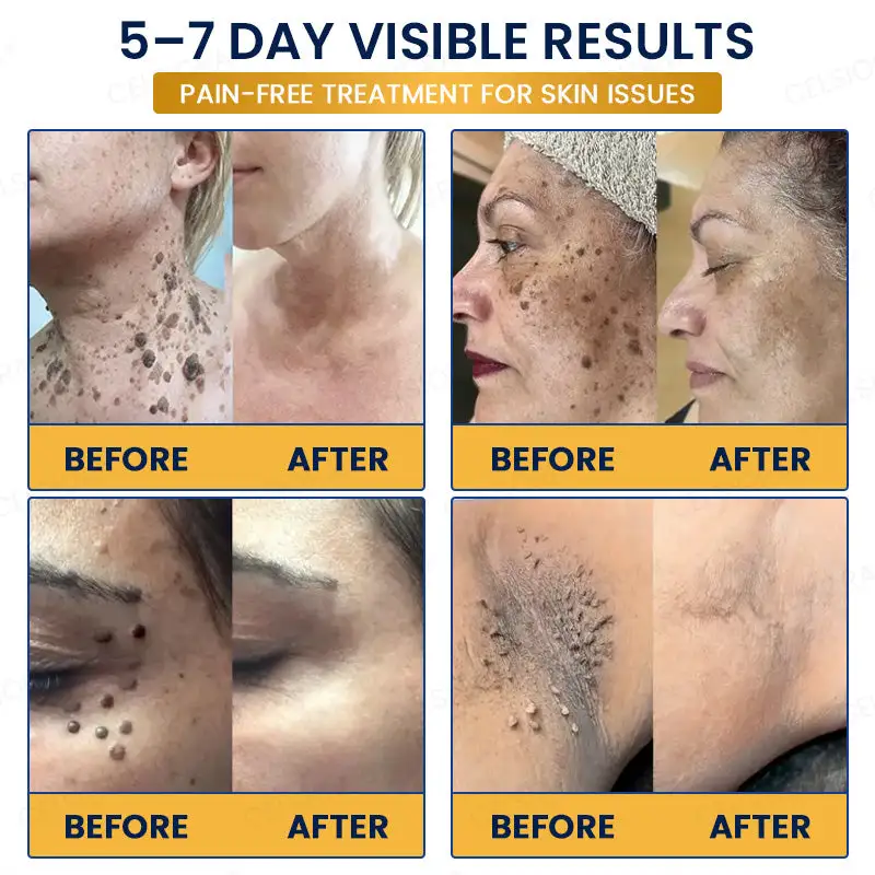 GFOUK® 7-Day MicroNeedle Wart & Skin Tag Removal Patch - Image 2