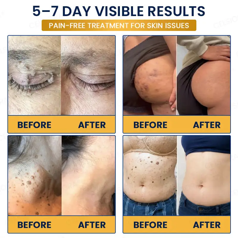 GFOUK® 7-Day MicroNeedle Wart & Skin Tag Removal Patch - Image 3