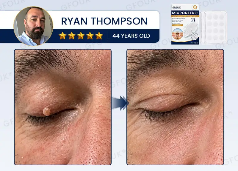 GFOUK® 7-Day MicroNeedle Wart & Skin Tag Removal Patch - Image 6