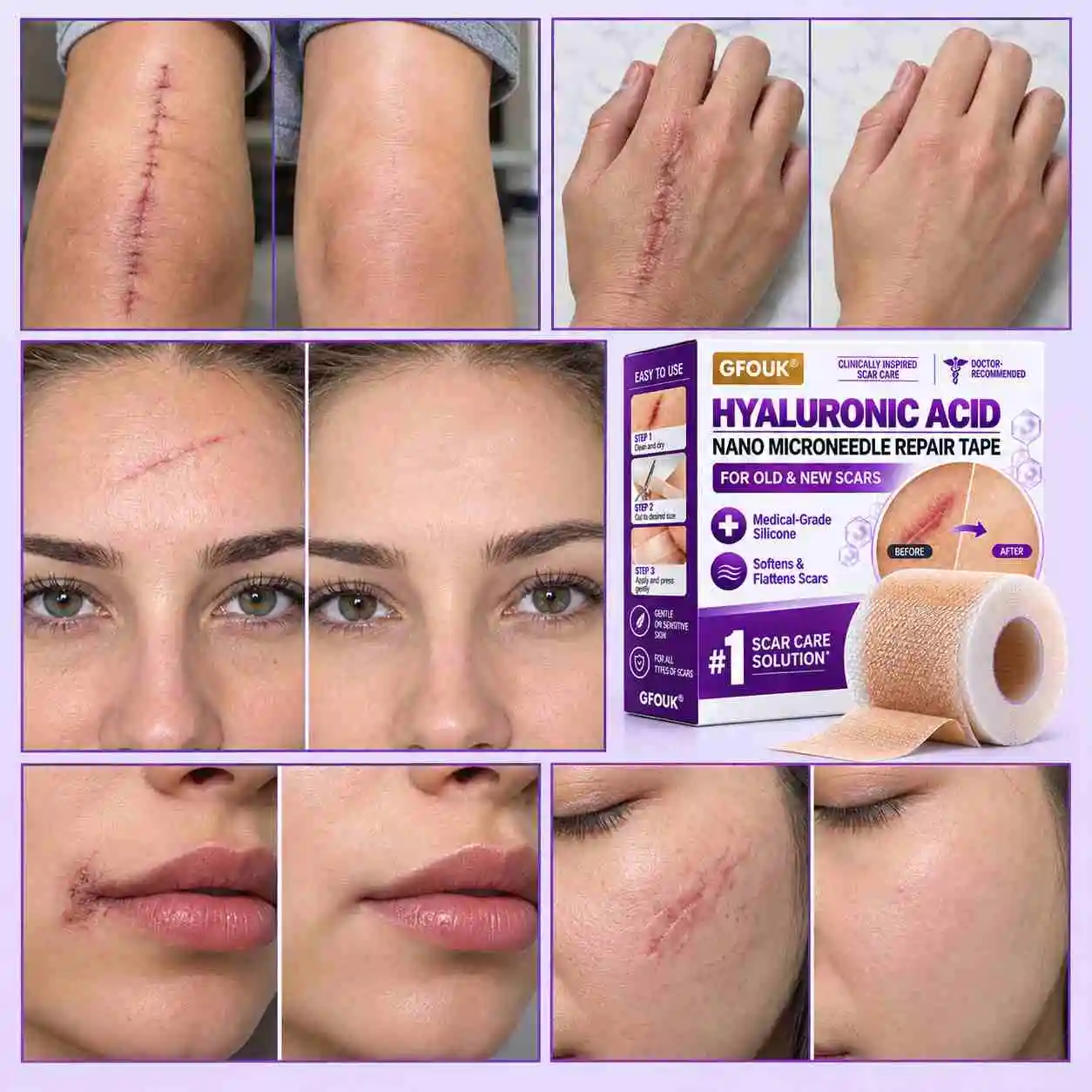 GFOUK® 7-Day Nano Microneedle Scar Repair Tape - Image 2