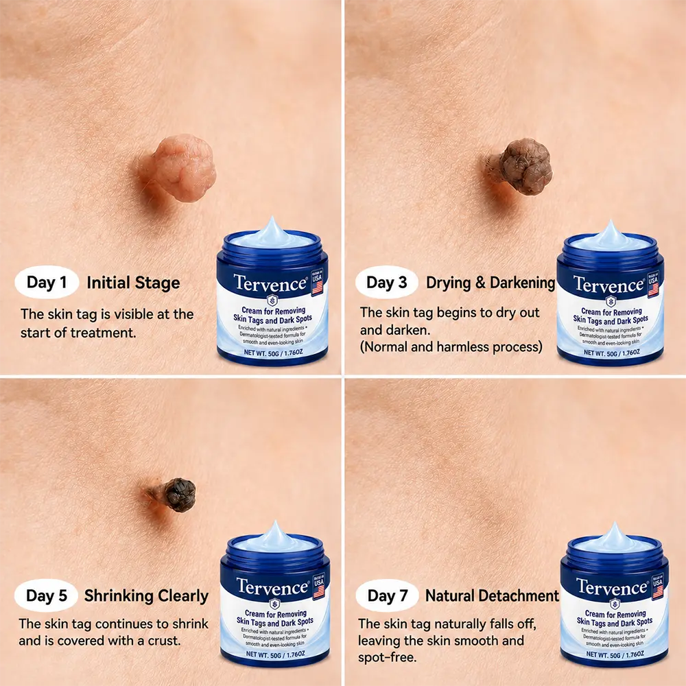 7-Day Skin Tag & Spot Care Cream - Image 4