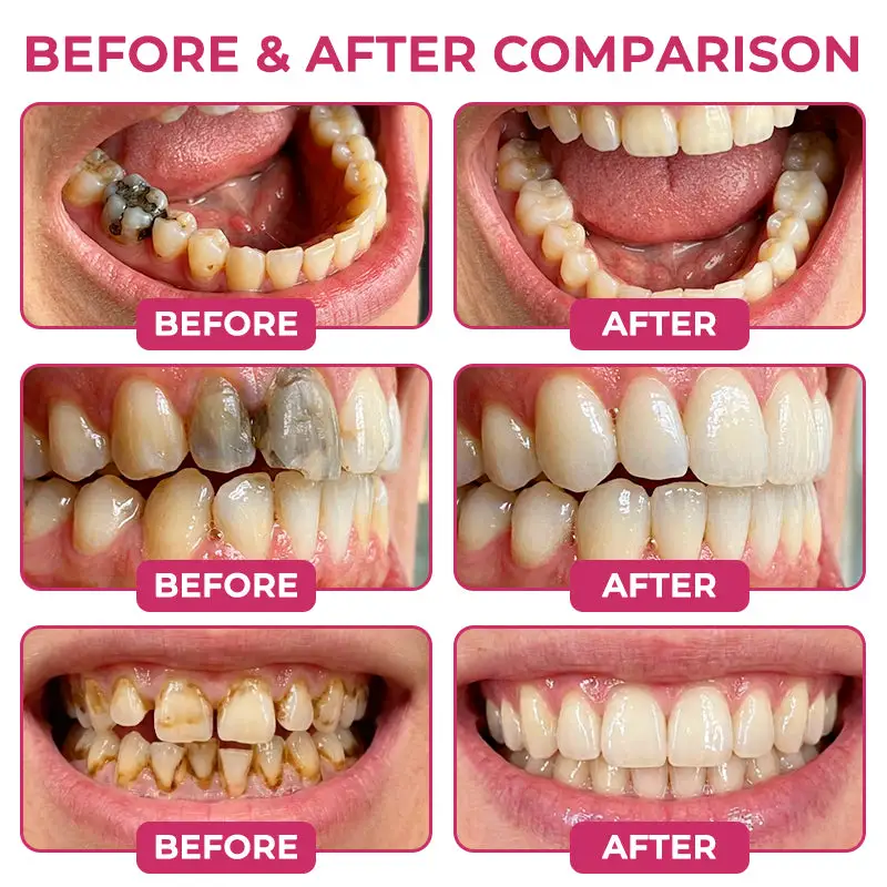 LIMETOW® Cavity-Repair Natural Enamel Filling Gel - Image 2