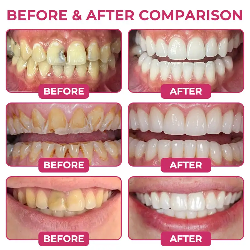 LIMETOW® Cavity-Repair Natural Enamel Filling Gel - Image 3